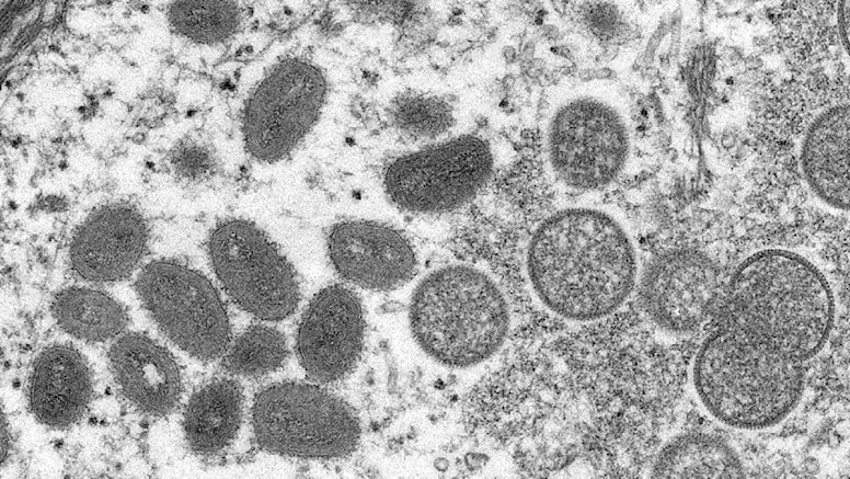 Avrupa'nın Ardından ABD'de Maymun Çiçeği Virüsü Büyük Endişe Yarattı